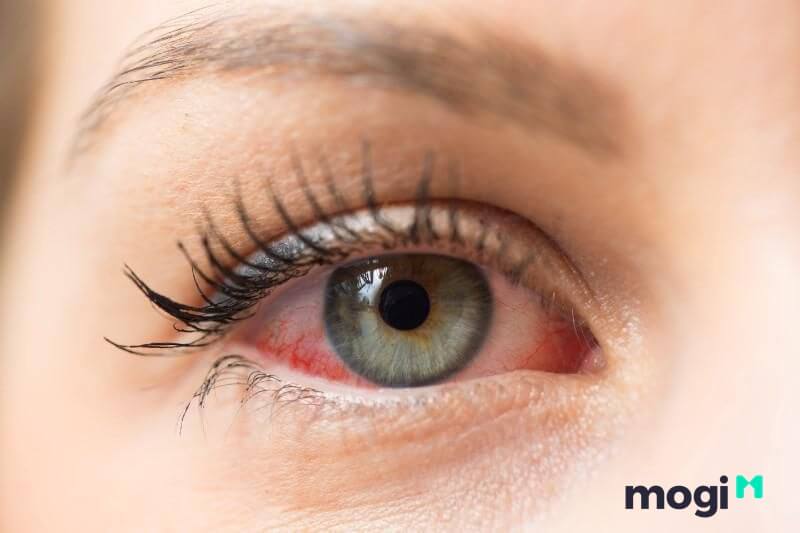 Theo khía cạnh khoa học thì mí mắt bị co giật chính là dấu hiệu cảnh báo vấn đề về sức khỏe của bạn.