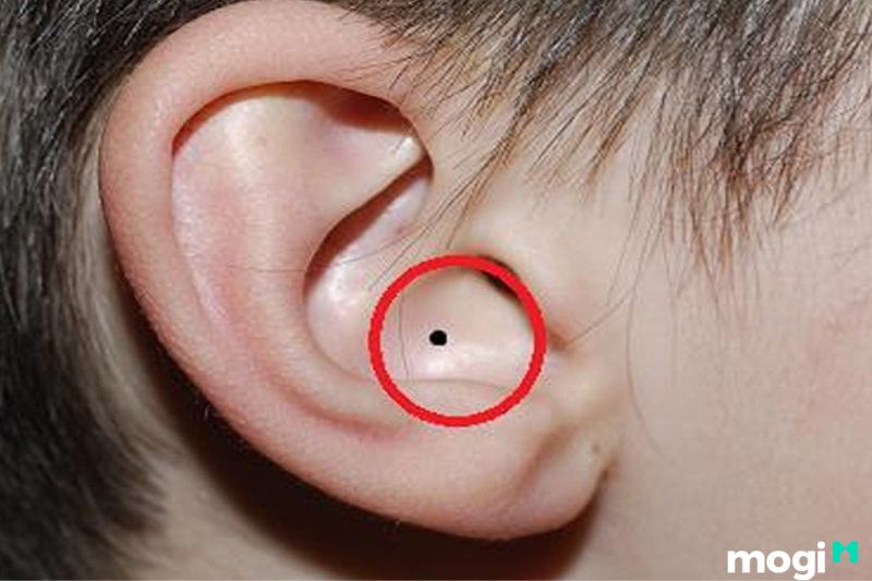 Nốt ruồi ở bên trong tai của nữ