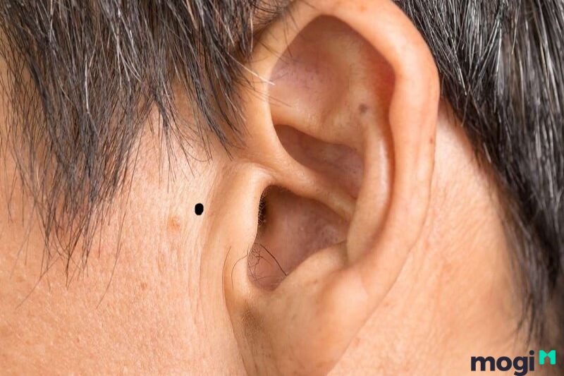 Nốt ruồi nằm ở gần tai của nam giới