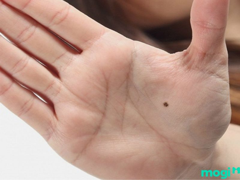 Nốt loài ruồi thâm trong thâm tâm bàn tay