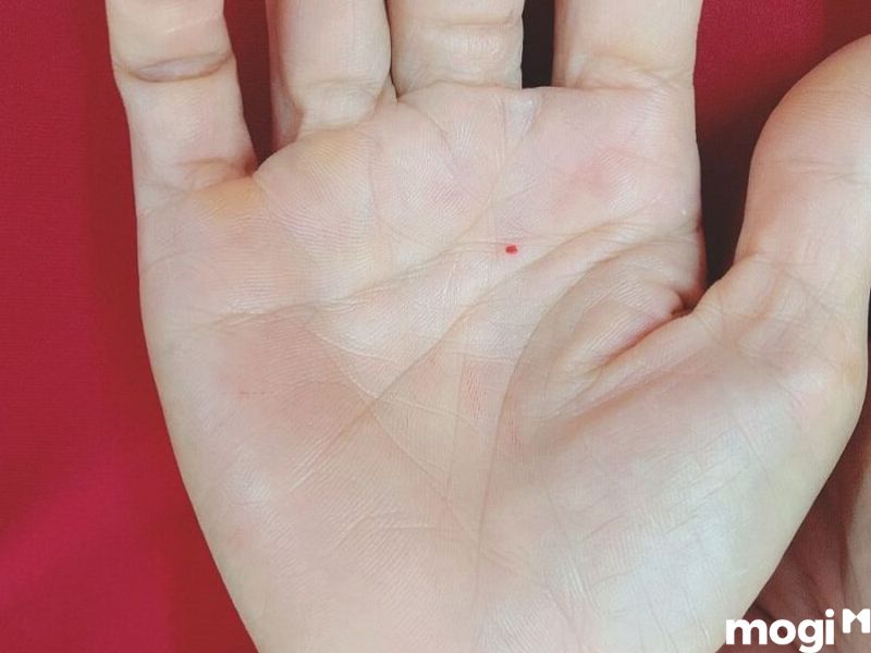 Có nên xoá nốt loài ruồi trong tim bàn tay hoặc không?