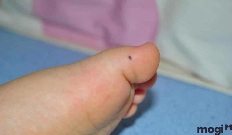 Nốt ruồi ở vị trí các ngón chân