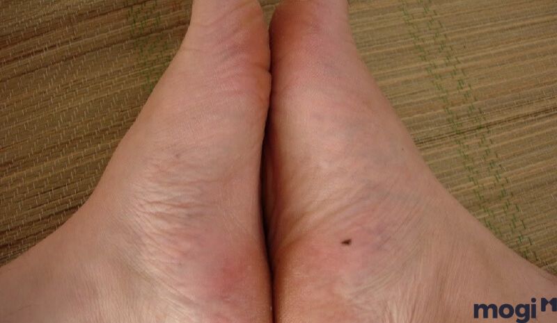 Nốt ruồi ở khu vực mép bàn chân