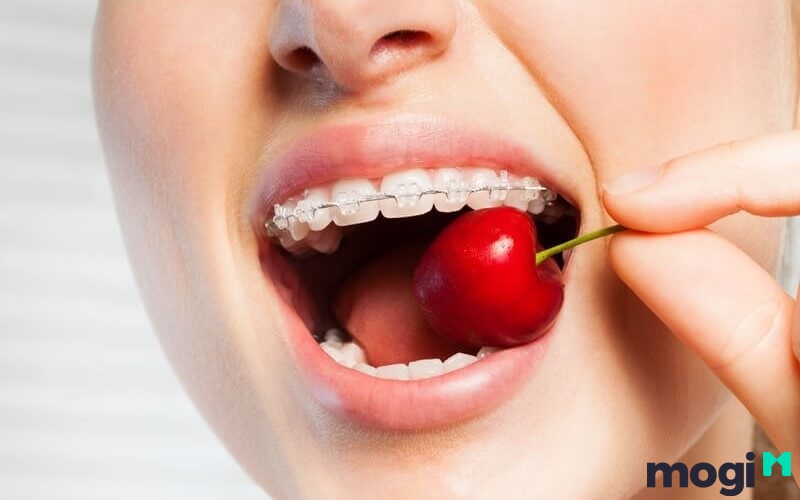 Khi niềng răng, ăn uống cần hạn chế những thực phẩm cứng