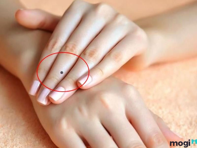 nốt con ruồi ở ngón tay