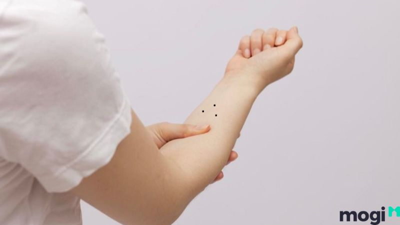 Nốt ruồi tạo hình tam giác trên cánh tay