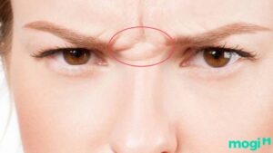 Sơn căn xuất hiện nếp nhăn thường được xem là dấu hiệu cuộc sống phải suy nghĩ nhiều, dễ gặp áp lực