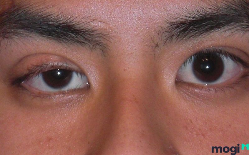 Mắt phải giật liên tục có thể do bạn đã mắc phải bệnh hiếm