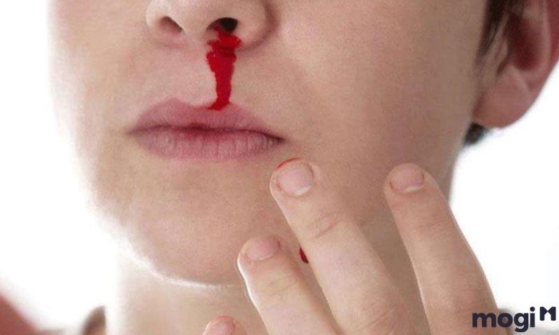 Nằm mơ thấy máu là điềm gì nếu máu chảy ở mũi?