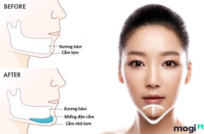 Phẫu thuật độn cằm cũng được áp dụng rộng rãi để tạo hình cằm nhọn.