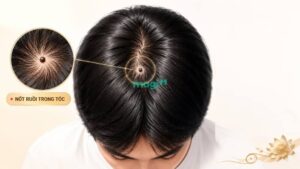 Nốt Ruồi Trên Đầu Có Ý Nghĩa Gì? Giải Mã 5+ Vị Trí Theo Nhân Tướng Học 4 Nốt ruồi trong tóc mang ý nghĩa là có quý nhân phù trợ, luôn được may mắn