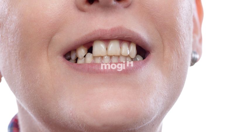 Mơ thấy gãy răng nhưng không chảy máu