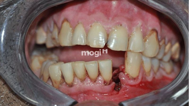 Mơ thấy răng hàm dưới bị gãy