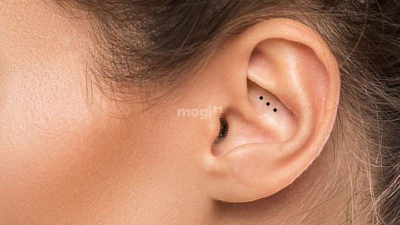 Nốt ruồi ở trong tai