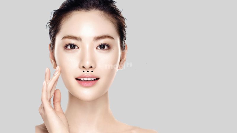 Nốt ruồi ở nhân trung