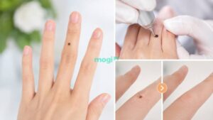 Nốt Ruồi Ngón Tay Giữa Là Gì? Tốt Hay Xấu? Giải Mã Chi Tiết Nhất 4 Tùy thuộc vào nhiều yếu tố mà cân nhắc việc tẩy nốt ruồi