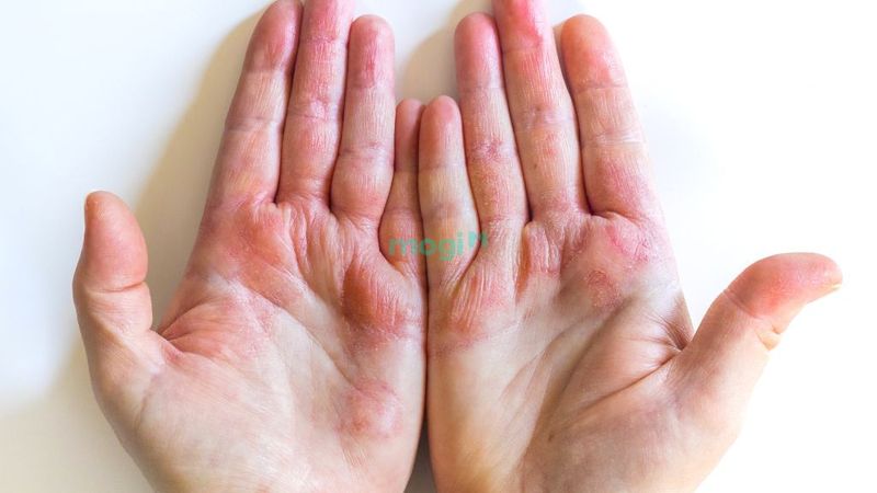 Nguyên nhân lòng bàn tay phải bị ngứa